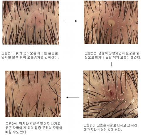 머리가 계속 간지럽다면?!