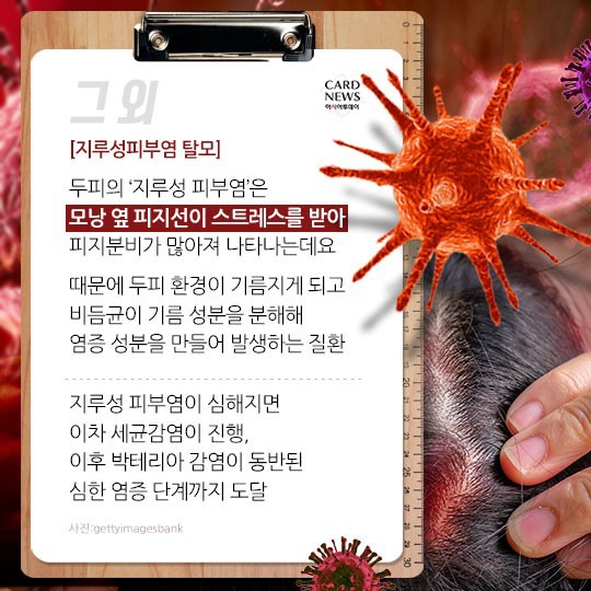 [카드뉴스] “소중한 머리카락 왜 자꾸 빠질까?”... 탈모 원인 및 치료법? 