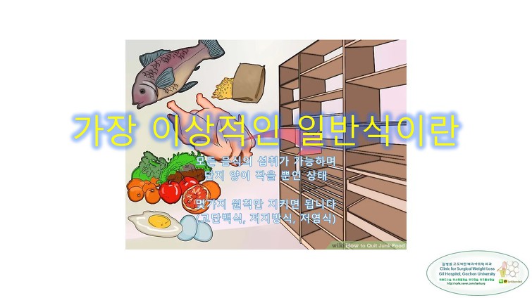 고도비만수술의 대세 위소매절제술 후 일반식하기