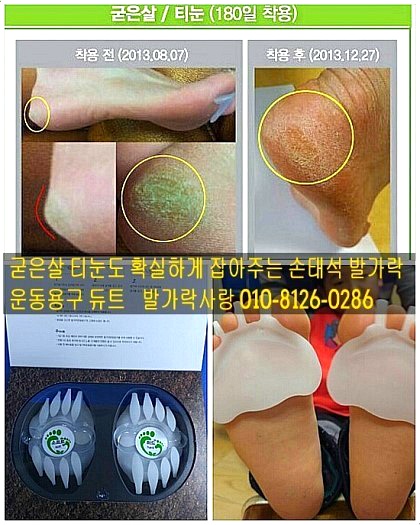 티눈엔 발가락 운동용구 듀트